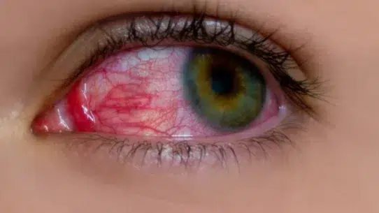 eye allergy treatment