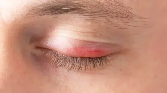 how to treat a swollen eye