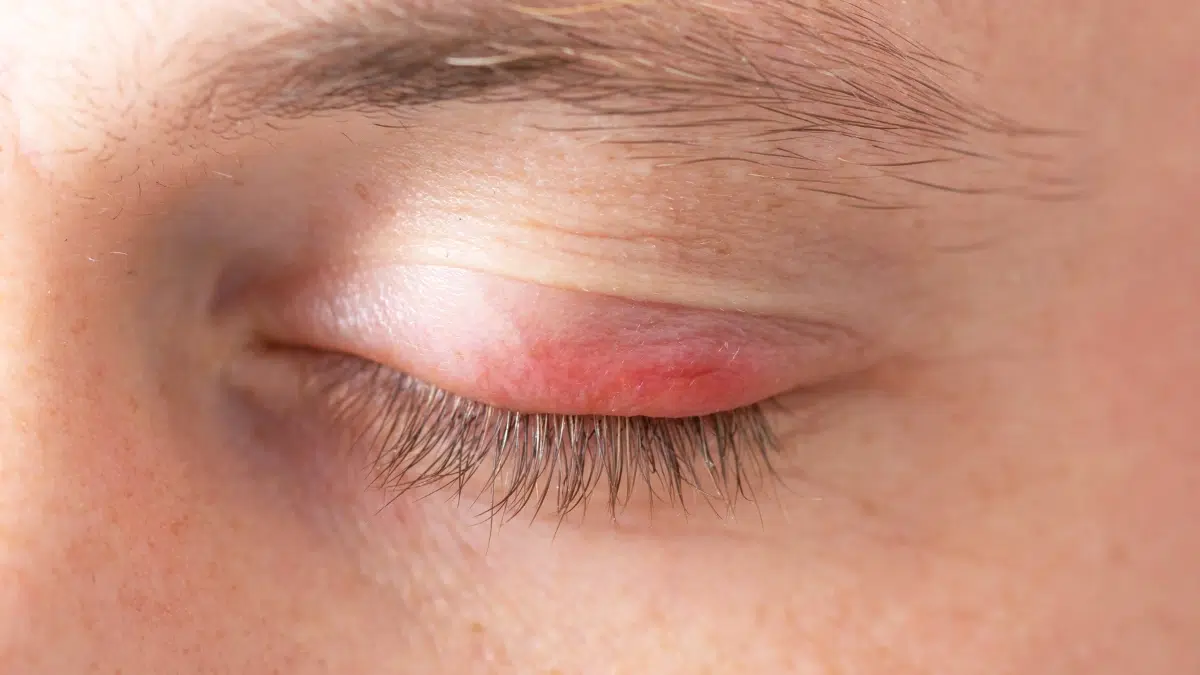 how to treat a swollen eye