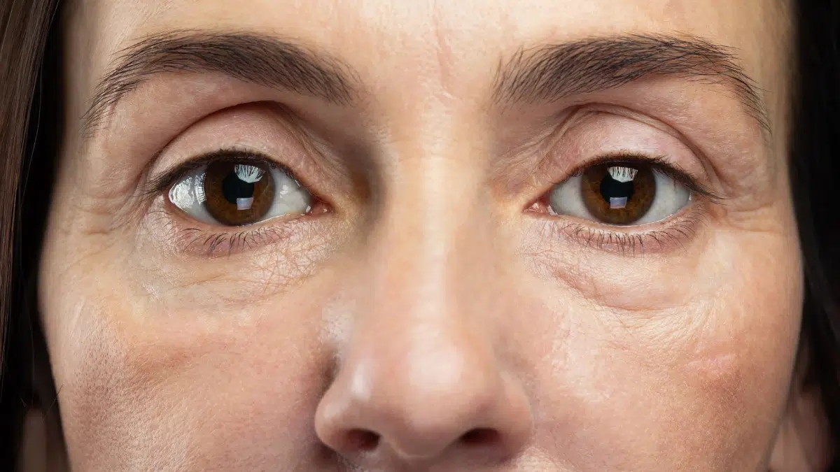 hypothyroidism puffy eyes