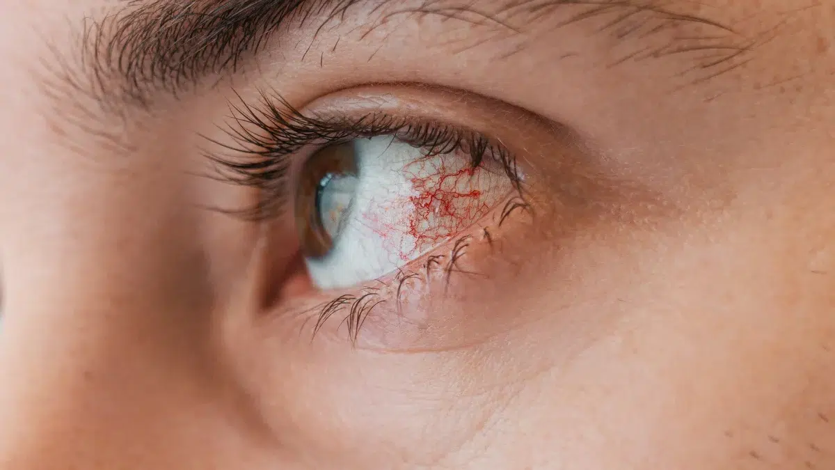 keratitis
