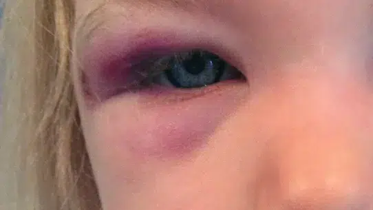 medication for swollen eye