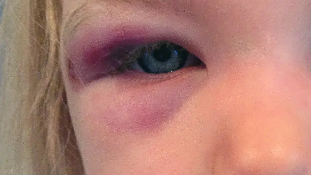 medication for swollen eye