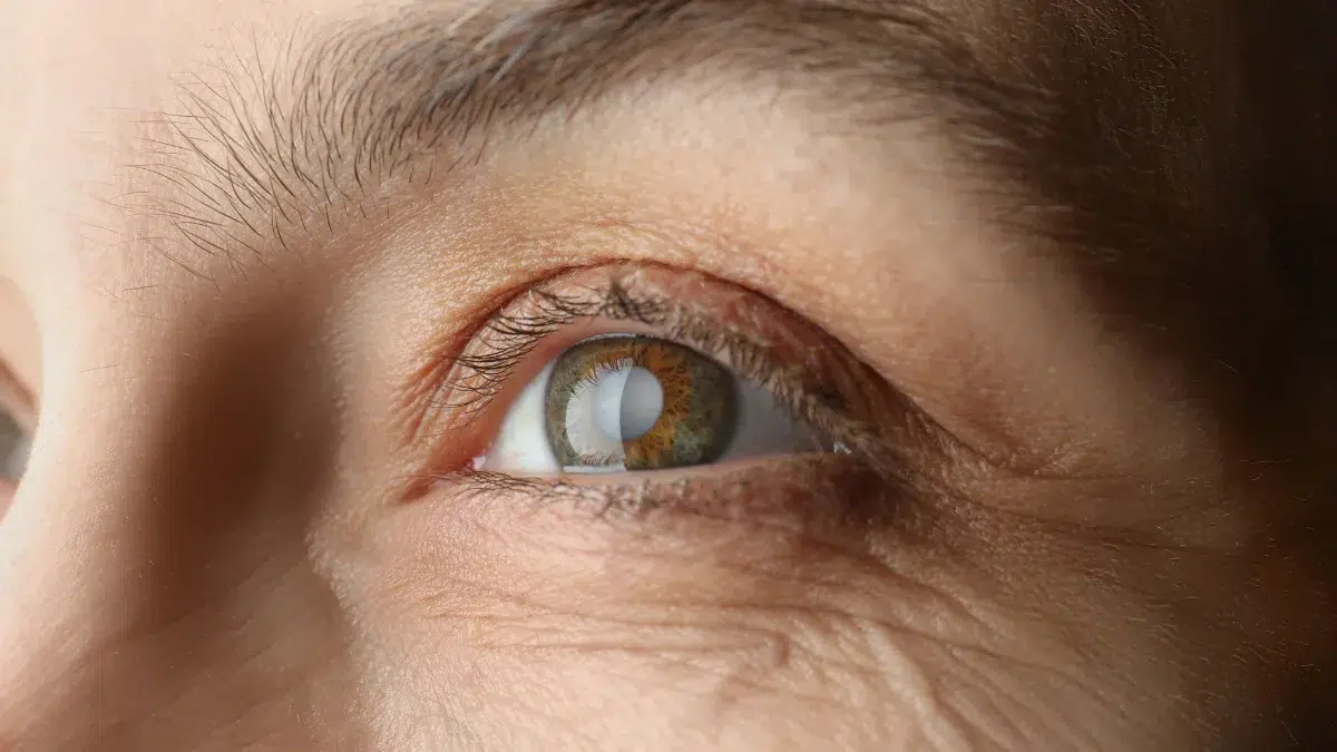 nuclear cataract