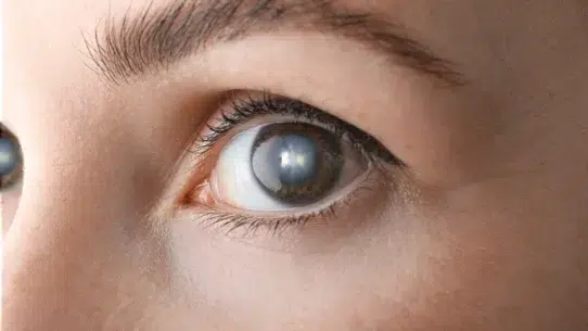 posterior polar cataract