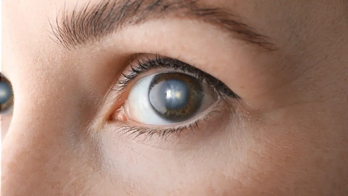 posterior polar cataract