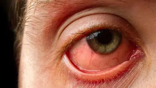 red eyes