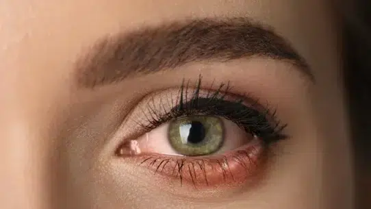 red eyes from allergies