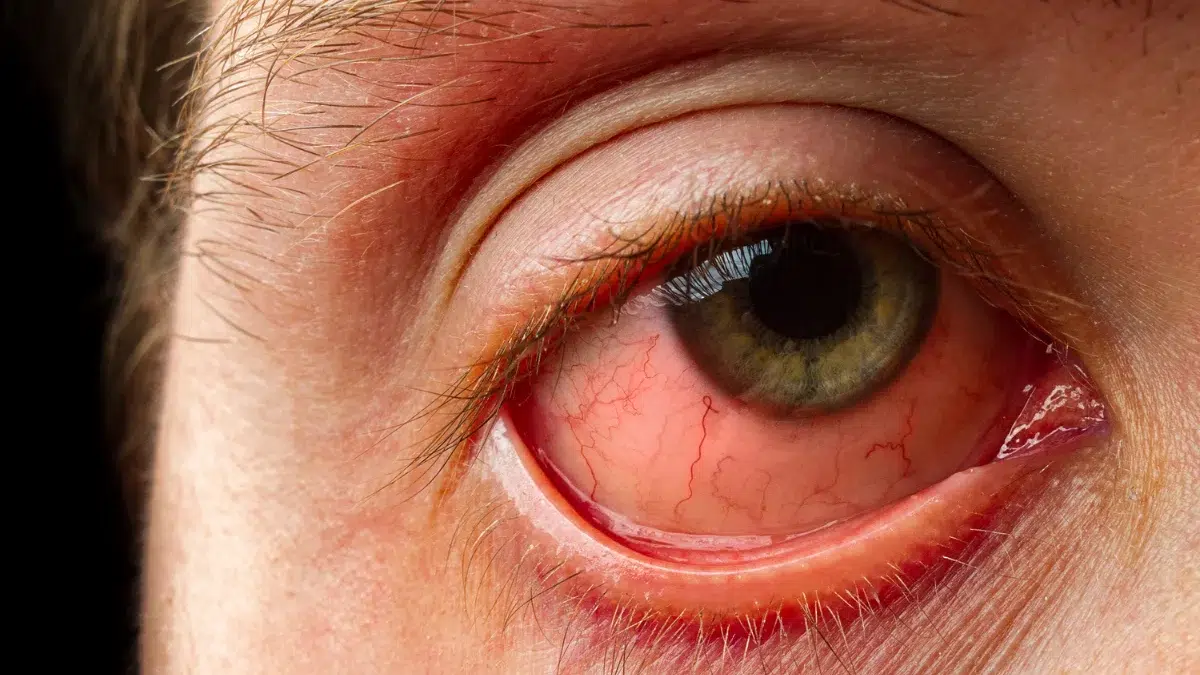 red eyes