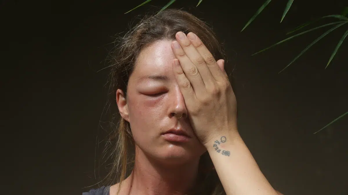 swollen eye from allergies