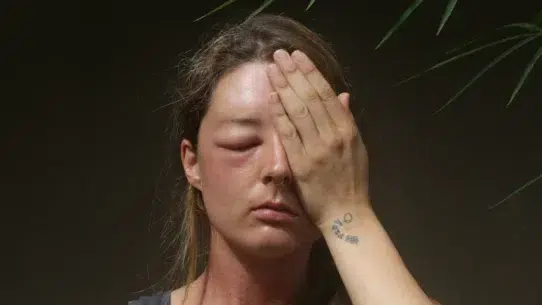 swollen eye remedies