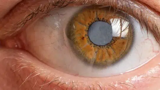 what causes cataracts