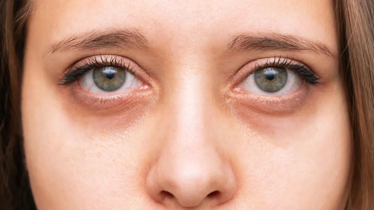 what causes dark circles under eyes
