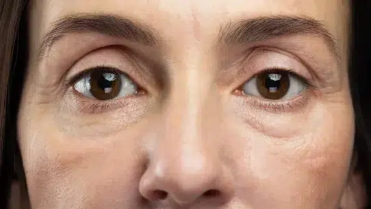 what causes puffy eyes
