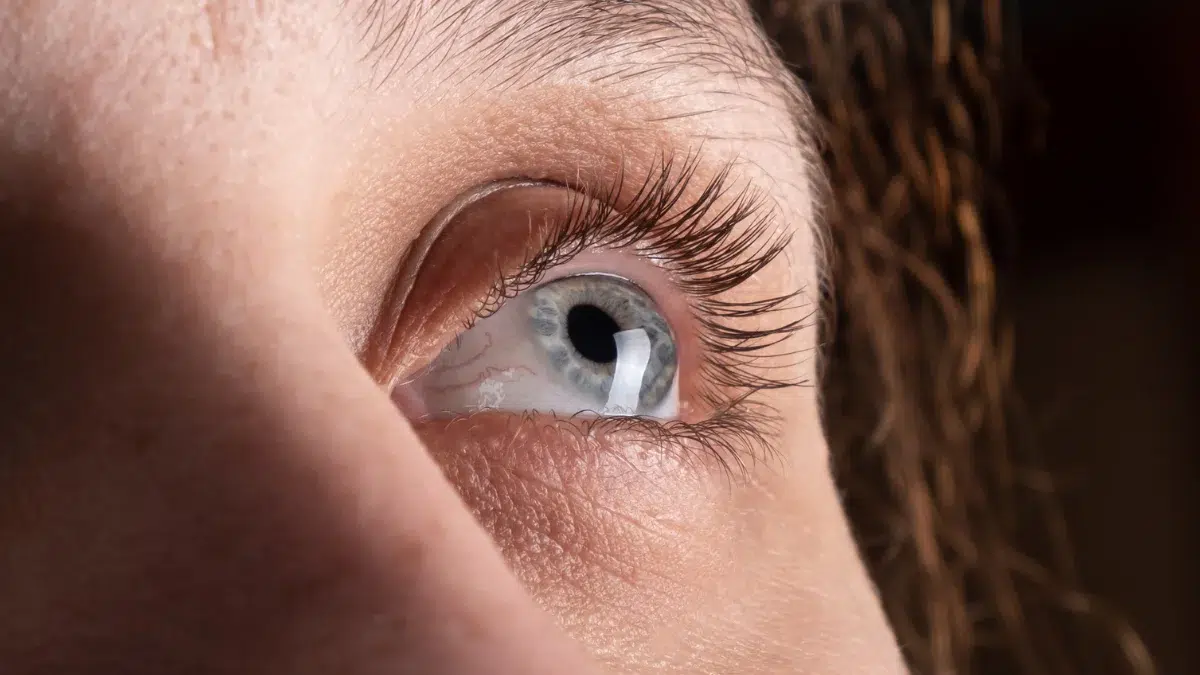 keratoconus causes