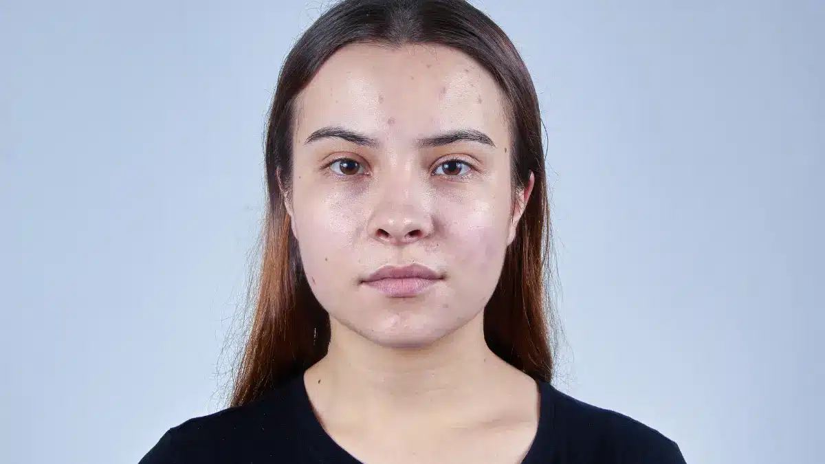 pcos acne