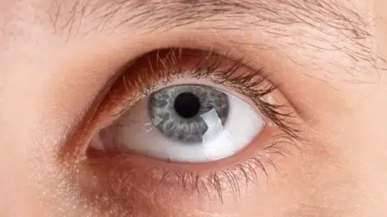corneal ulcer