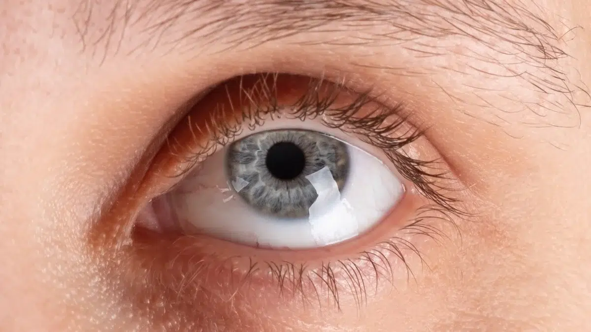 corneal ulcer