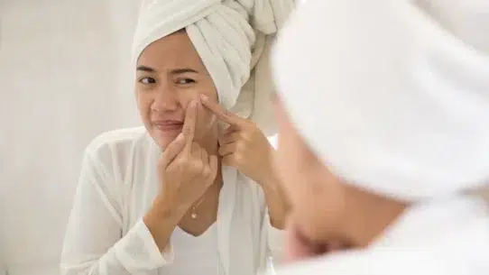pms acne