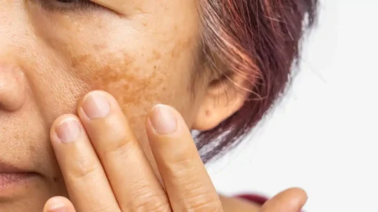 menopause-skin-changes